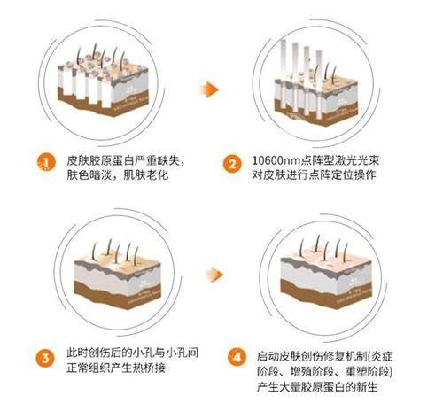 点阵激光治疗疤痕成效好吗？真实术例对比+术后护理指南，凹凸疤/痘坑能否平滑如新一次说清！