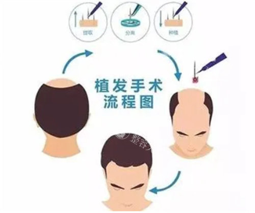 西安植发大概多少钱？5000元起至3万+，发际线/头顶加密差价大！