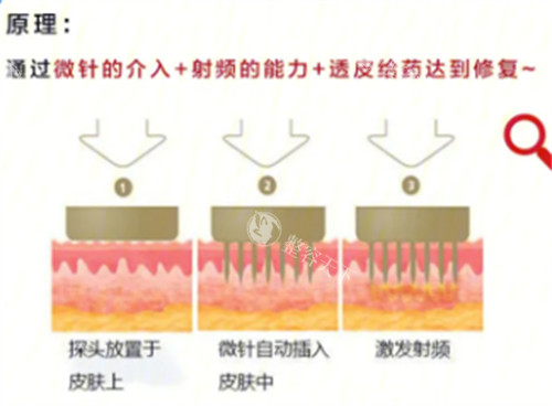 黄金微针5代一次价格是多少钱？新一代6000元起无复原期，毛孔痘坑肌的性价比焕肤指南