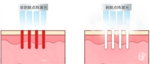 点阵激光治疗疤痕成效好吗？真实术例对比+术后护理指南，凹凸疤/痘坑能否平滑如新一次说清！