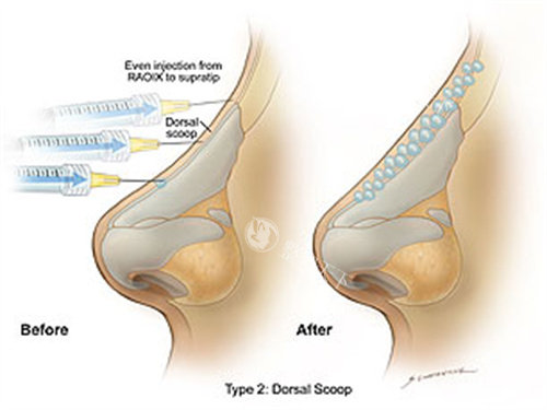 海魅玻尿酸好还是乔雅登好？从成分与技术、改善优势、适用人群、术后展现等对比