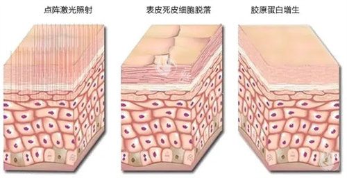 做点阵激光正规医院多少钱一次？痘疤色斑治疗必看：局部1500vs全脸8000元费用解析