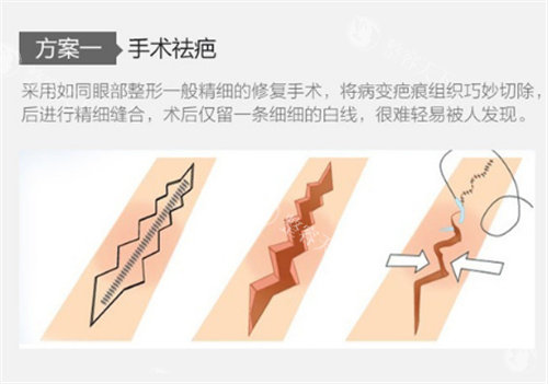 十厘米疤痕修复后如何护理？综合医院术后护理费用！