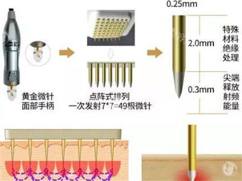 黑曜双波Sylfirm X黄金微针介绍:突破单极射频局限,双波分层紧肤与适用人群