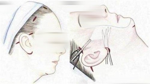 2025北京拉皮医院排行榜：艺美医疗美容技术专有盘点！