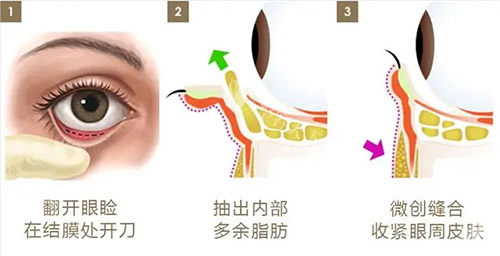 吉首星美医疗美容去眼袋多少钱？3000元左右轻松消除眼袋，告别显老烦恼快速拥有年轻电眼！