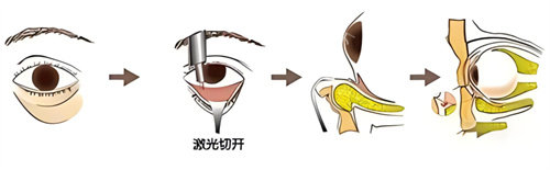 西安孙峰眼袋失败修复到底要花多少钱？不同情况16800元至39800元不等，这份价目攻略请收好！
