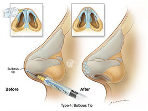 凝胶型玻尿酸有哪些牌子？乔雅登、瑞蓝、菲欧曼、润百颜、宝尼达等都是