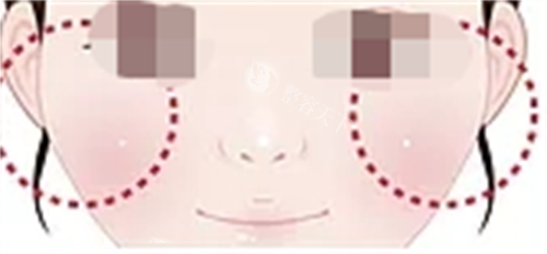 南宁华美打玻尿酸多少钱？乔雅登雅致6000元起、润百颜2000元起