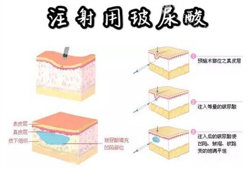 海魅玻尿酸好还是乔雅登好？从成分与技术、改善优势、适用人群、术后展现等对比