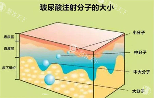 南宁华美打玻尿酸多少钱？乔雅登雅致6000元起、润百颜2000元起