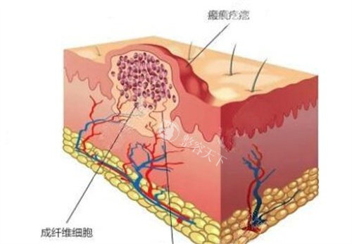 2025武晓莉疤痕手术收费标准：切除缝合2000+疤痕疙瘩8000+剖腹产2000+高难度疤痕8500+