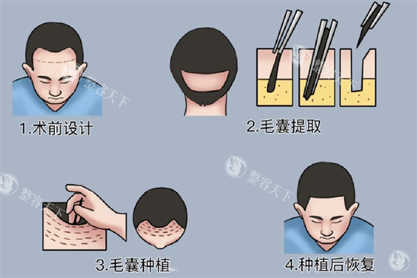 广州荔医植发怎么样？实操测评技术、医生、价格全解析，从毛囊存活率到性价比一篇说透值不值！