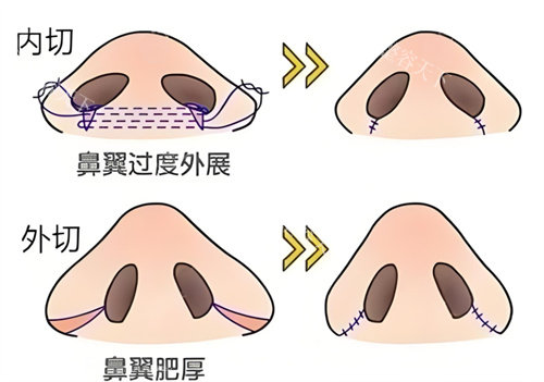 缩鼻翼手术方式有哪些？哪个方式好？对比鼻翼切除|鼻翼内收|鼻翼基底切除等