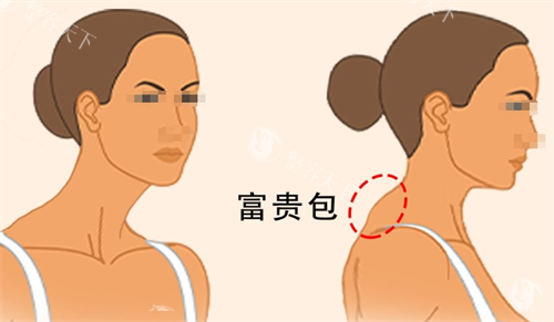 黄学峰消除富贵包是真的吗？技术真实有效，小创口改善快还低复发率