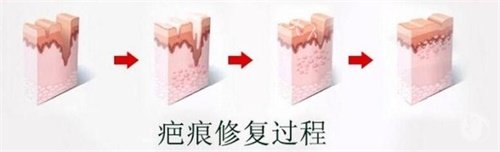 疤痕修复手术一般多少钱？一般在2000元到20000元之间