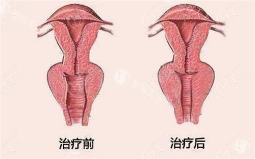 了解女性打紧缩针一针的费用，经济实惠为女性私密健康保驾护航！