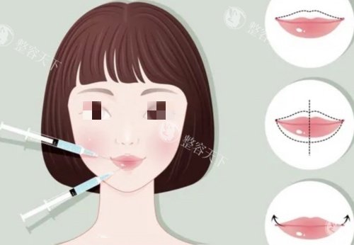 成都刘玉辉做唇结果怎么样？​他会精心设计手术切口，在术中细致地重塑唇部肌肉和组织，以达到改善唇形的目的