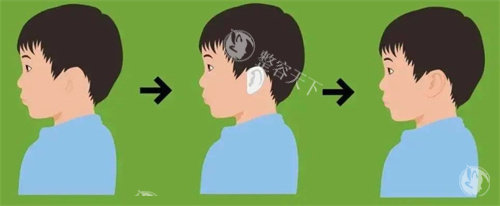 一度小耳畸形需要做手术吗？多位医生意见达成共识：这些情况可保守治疗！