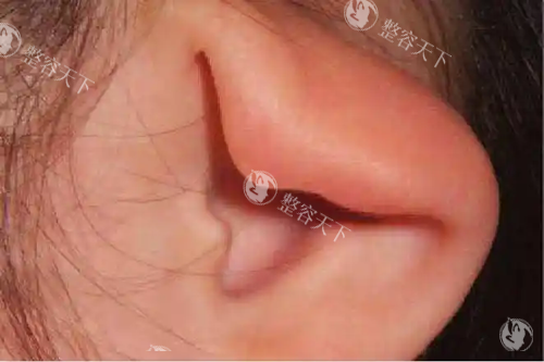 杯状耳有必要矫正吗？调查发现这2类矫正器可能导致软骨损伤！