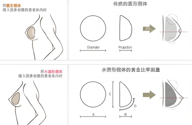 隆胸假体取出费用包含哪些？麻醉/检查/修复的详细开支拆解！