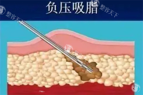 南京张荣明吸脂手术做的好吗？当然好！且有多年丰富的经验、吸脂精细化定位、创口小无痕！