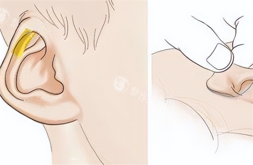 国内耳再造手术谁做得好？郭树忠、邓正军、王永振三位都是国内耳再造技术有名的医生