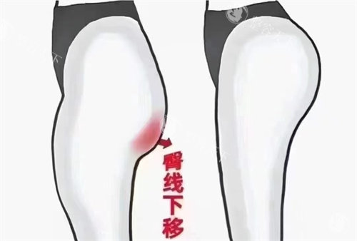 自体脂肪填充和胶原蛋白填充哪个好？两者都是填充成效比较好的选择/附上优缺点分析
