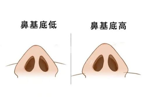 鼻子假体30年了不取没事吗？长期留存的5大潜在风险与定期检查建议！