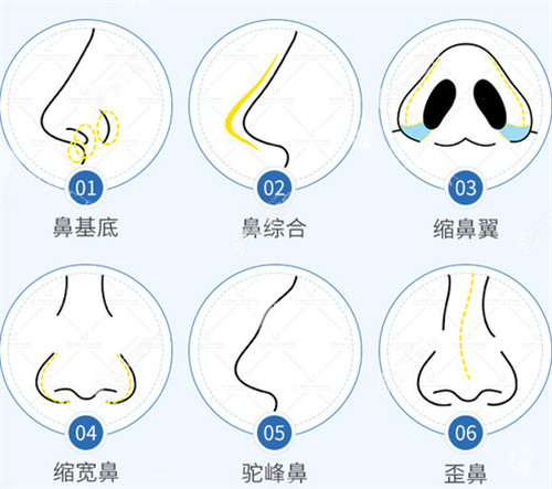 惊！鼻子假体取出要花多少钱？2025年新价格大公开！