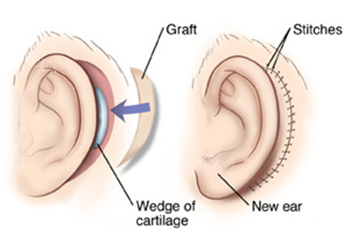 上海耳朵再造手术费用参考：肋软骨10-14万起，支架材料7-10万起
