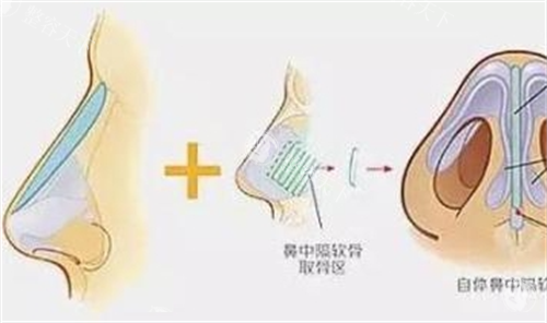 隆鼻术后挛缩如何破？3招有效缓解鼻小柱牵拉感的实用技巧！