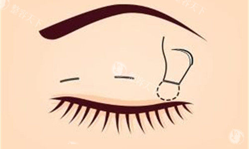 卢尚兵修复双眼皮怎么样？做眼修复价格贵吗？整友认可的可靠眼修复医生眼修复2万起