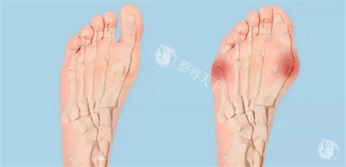 大脚趾外翻怎么治疗?还能穿高跟鞋吗?揭秘3步拯救变形足
