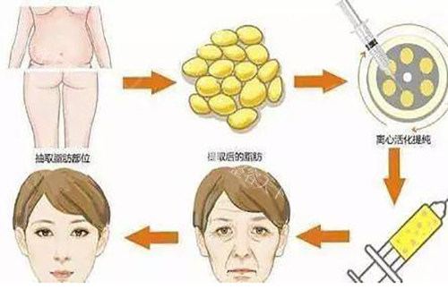 北京脂肪填充专门医院推荐!禾美嘉/润美玉之光/纯脂/京韩/都是做脂肪整形有实力的机构