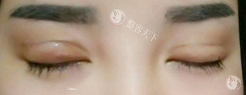 成都高亮眼修复怎么样？高亮和卢尚兵谁的技术好？技术特色深度解析