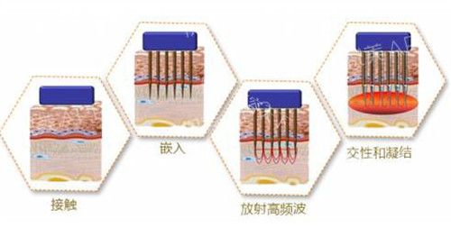 进口美迪迈黄金微针国内有吗?有!分享北上广深等多城授权医院名单