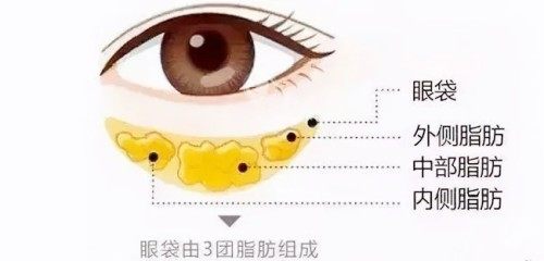 眼袋分为哪几种类型？下睑袋型、眶下沟型、混合型、肌性眼袋和皮肤松弛型