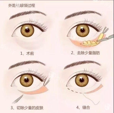 眼袋分为哪几种类型？下睑袋型、眶下沟型、混合型、肌性眼袋和皮肤松弛型