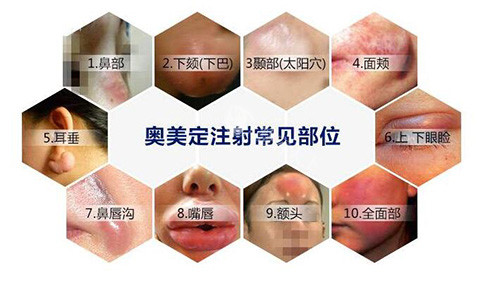 亲历广州奥美定取出手术：医生技术选择与费用明细实录！