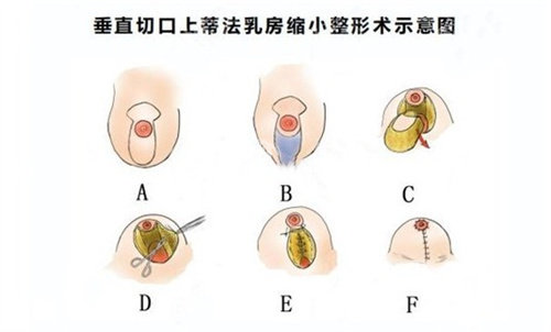 杭州栗勇缩胸手术怎么样?实测：切口隐藏乳晕，C杯→B杯自然胸型!