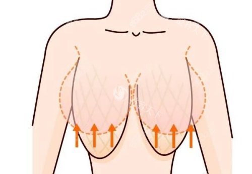 杭州栗勇缩胸手术怎么样?实测：切口隐藏乳晕，C杯→B杯自然胸型!