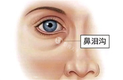 泪沟内切能维持多久？一般维持1-5年左右/和个人体质&医生技术等有关