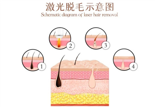 昆明哪里可以做激光脱毛？华美美莱/艺星/梦想激光脱毛的优势和价格对比一览