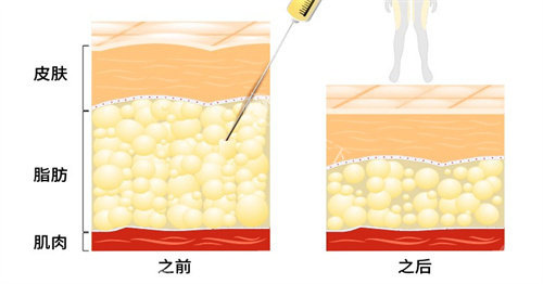 武汉包涛和郑洋抽脂谁好？从技术特色到口碑反馈，一文揭秘两位医生抽脂优势差异