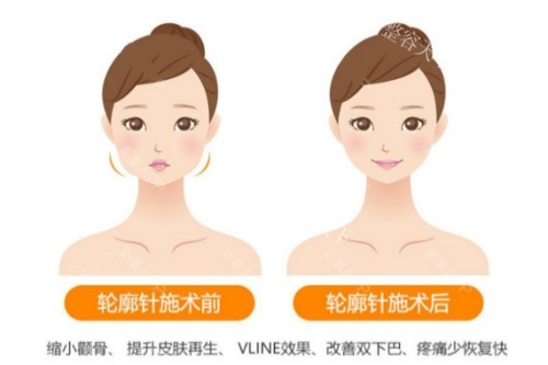 有人去过杭州美莱医院找栗勇吗?亲历者分享:做轮廓三件套,术后15天敢素颜出门！