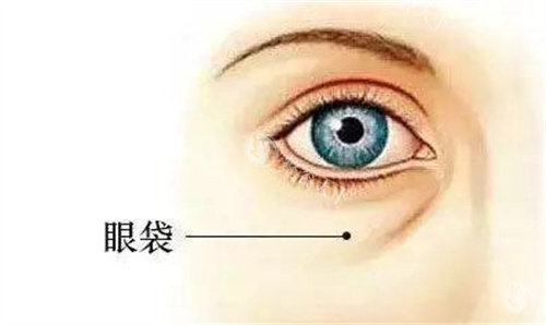 大连张井忠眼袋手术方式全览：内切vs外切的适应人群！