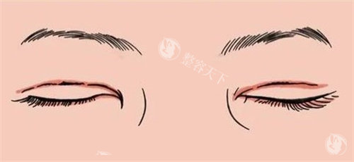 董瑞芳双眼皮修复成功实例：肉条感消失术+眼型调整心得！