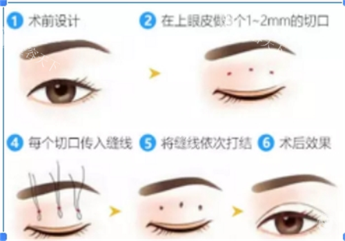 深圳艺星真的靠谱吗？从面诊到术后的全流程体验，口碑好到超出预期