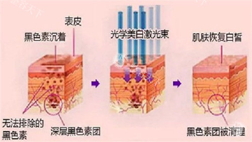 飞顿牛奶光和光子有什么区别？在技术原理|治疗特性|适应症|价格方面均有差异